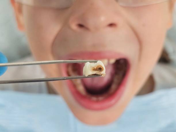 Best Same-Day Emergency Dentist in Coushatta, LA