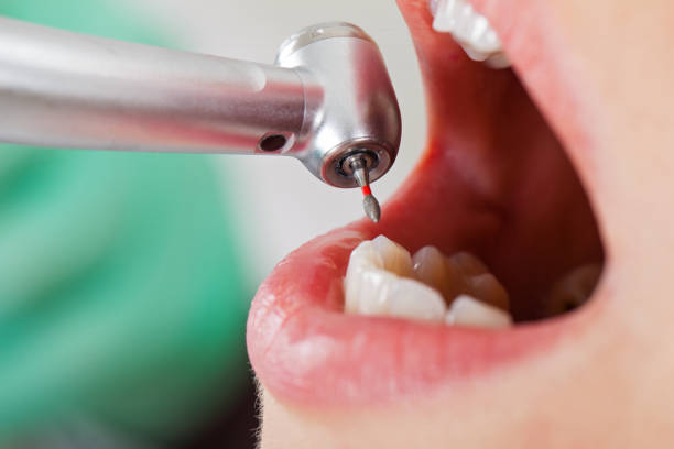 Best Emergency Wisdom Teeth Removal in Coushatta, LA